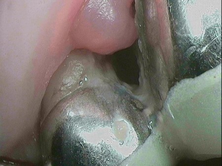 Die Folgen der Plaque und Parodontitis: Zahnfleisch- und Knochenrückgang.