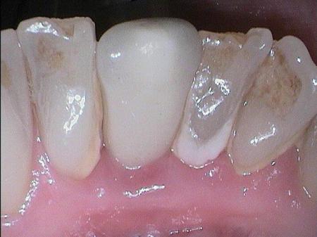 Vollkeramikkronen können natürlichen Zähnen in puncto Glätte absolut überlegen sein